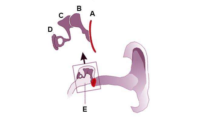 Тимпанопластика отзывы. Тимпанопластика показания. Операция на ухо тимпанопластика.